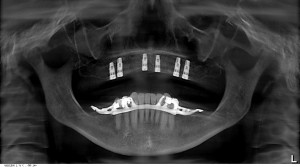 Scan d'Angèle avec ses 6 implants pour prothèse fixe.