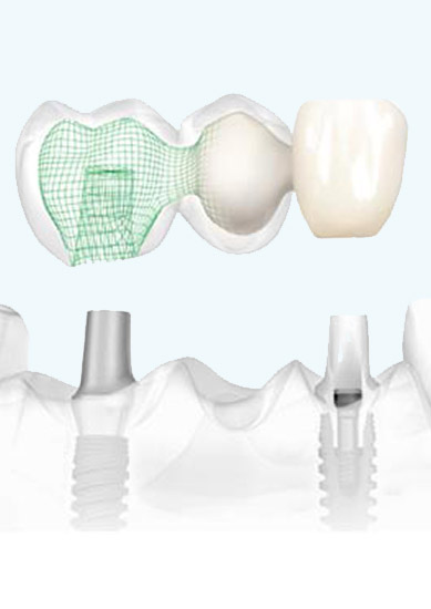 Déroulement - Pose Plusieurs dents sur implants