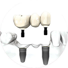 Avantages - Plusieurs dents sur implants