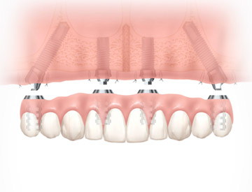 Prothèse sur implants en haut (maxillaire) fixe (conventionelle ou All-on-4 TM)