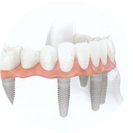 Prothèse fixe « conventionnelle » (mandibule)