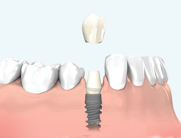 Dent unitaire sur implant