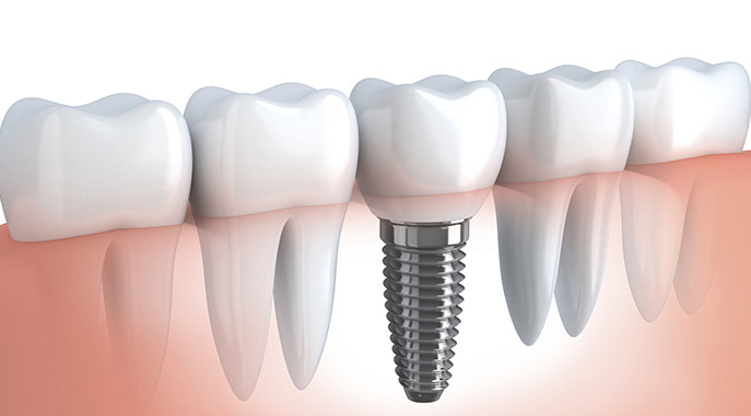 Dent unitaire sur implant - Solution couronne dentaire