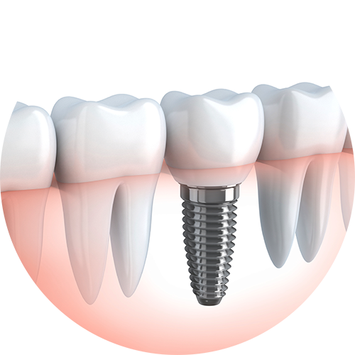 Dent unitaire sur implant