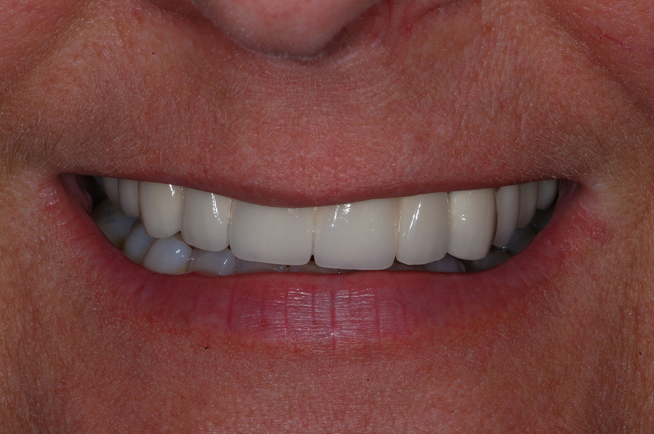 Murielle H. 40 ans. Pont de 6 dents sur implants dentaires - Après traitement