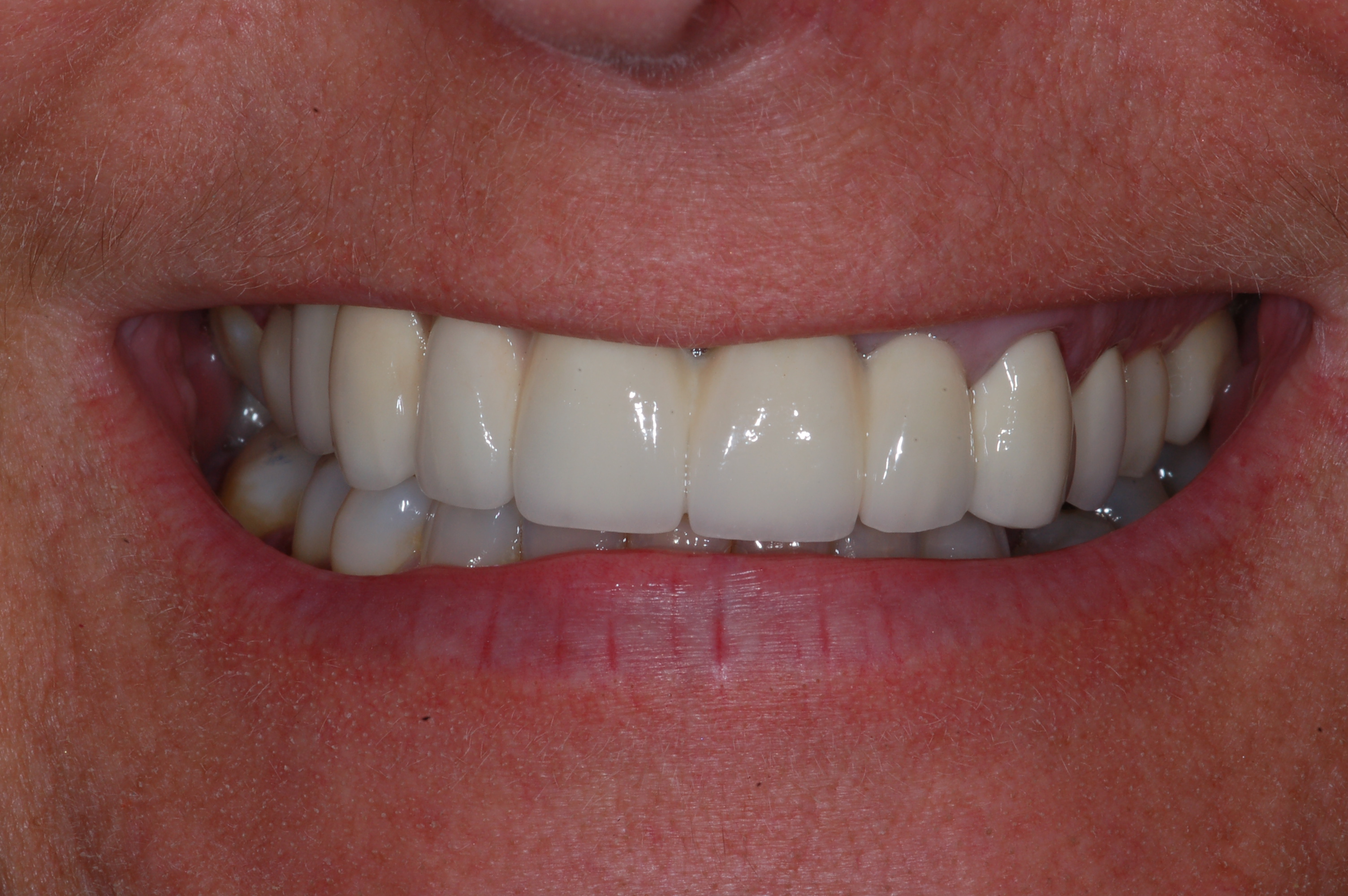 Murielle H. 40 ans. Pont de 6 dents sur implants - Avant traitement