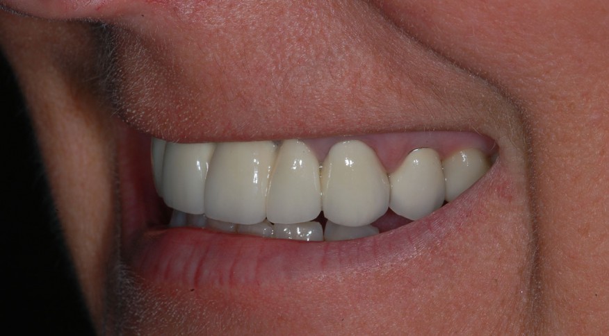 Murielle H. 40 ans. Pont de 6 dents sur implants - Après traitement
