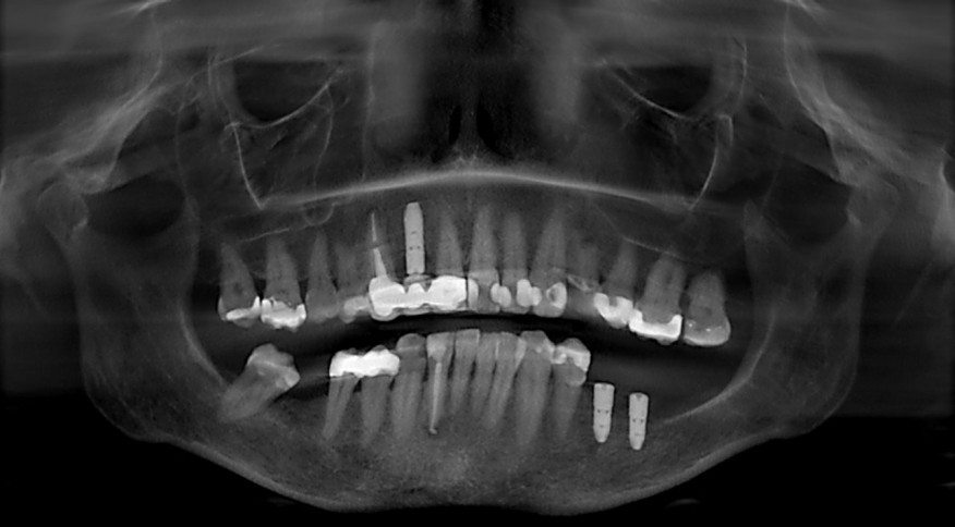 Radiographie - Couronnes - Michèle G, 57 ans. Dents unitaires sur implants.