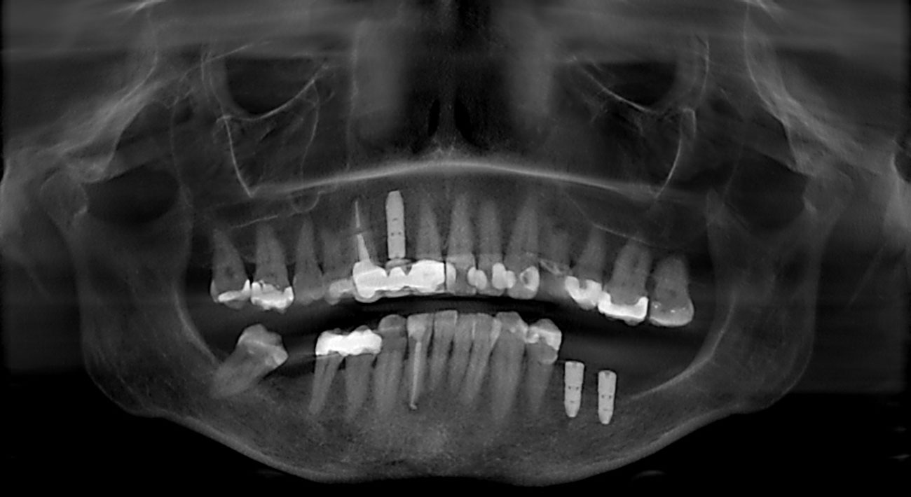 Radiographie - Couronnes - Michèle G, 57 ans. Dents unitaires sur implants.