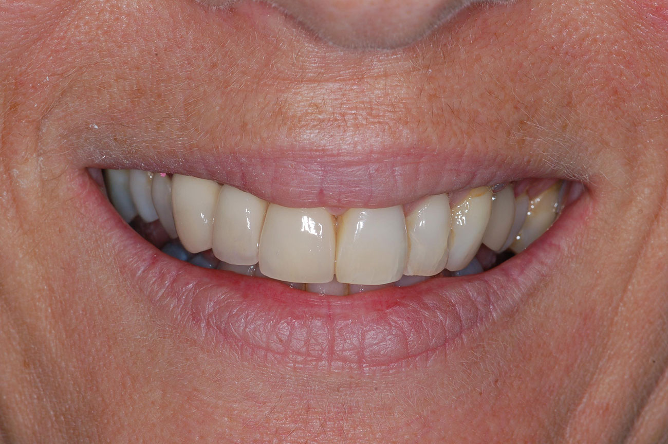 Michèle G, 57 ans. Dents unitaires sur implants. - Après traitement