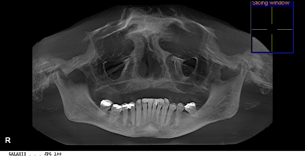 Scan 3D - Yvette C., 63 ans. Prothèse complète sur implant