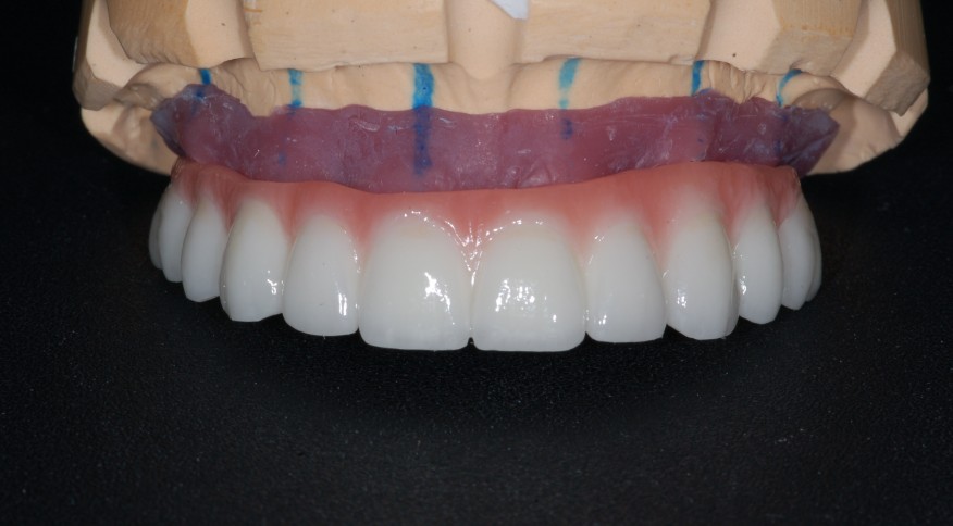 prothèse fixe sur implants dentaires.