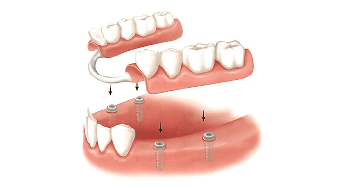 allegro implants dentaires