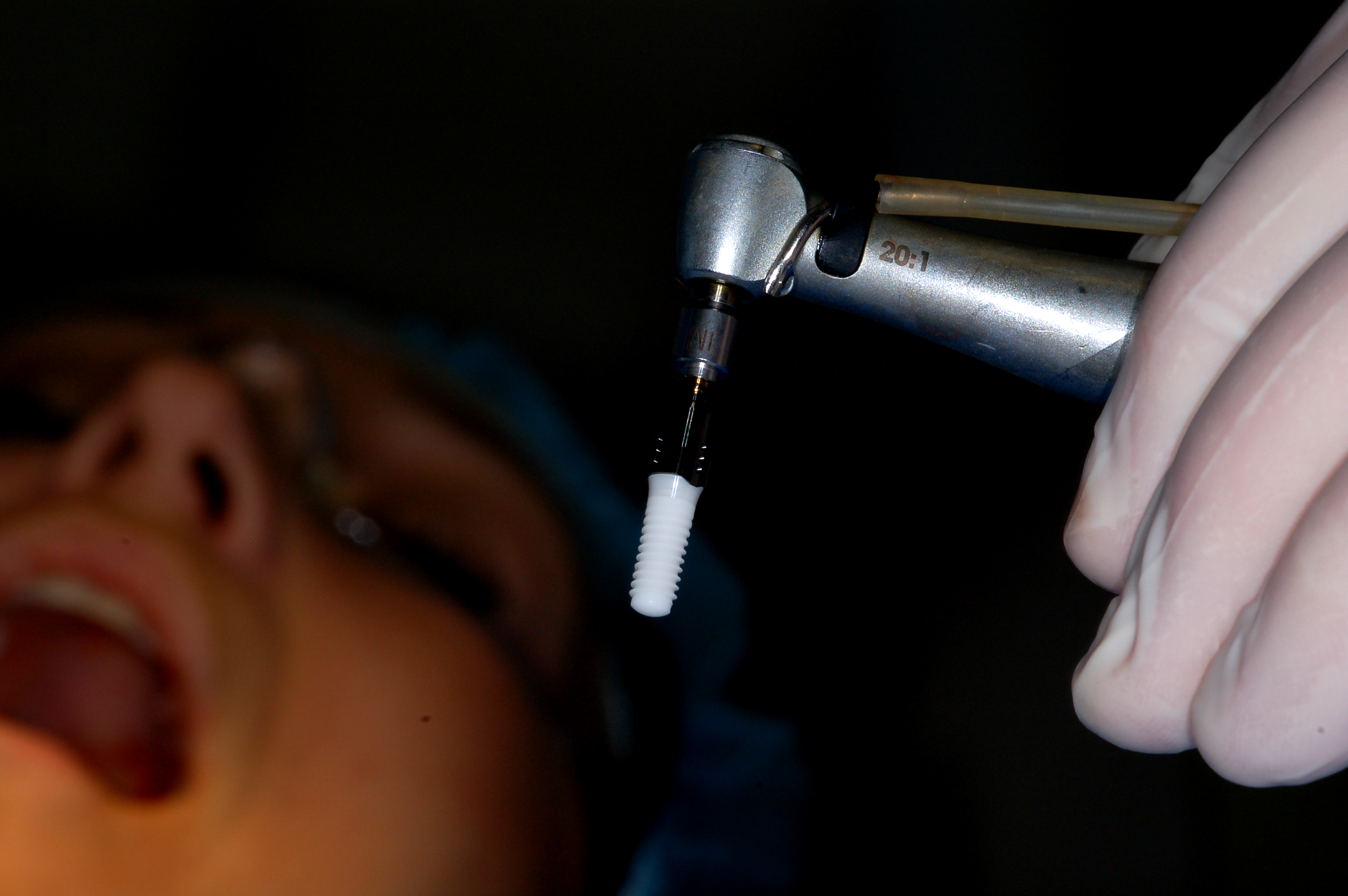 Implants dentaire unitaire sur porte implant