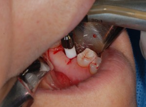 Implants dentaire en cours d'installation dans la bouche de la patiente en postérieur.